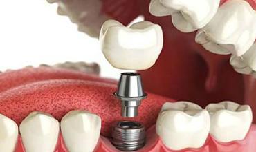 prosthodontics image