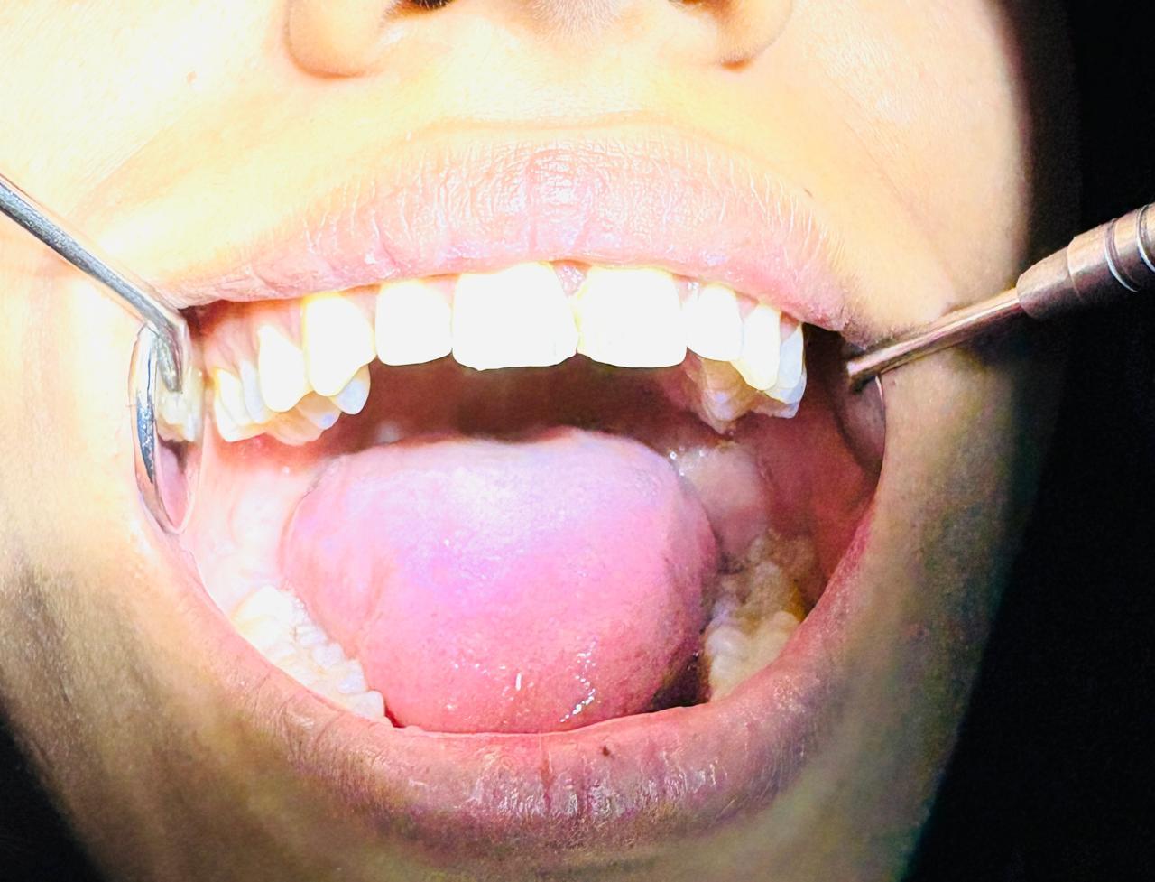 Dental Veneers in Burari — A flawless smile, tooth by tooth at Braces & Faces, Mayur Vihar Phase 1