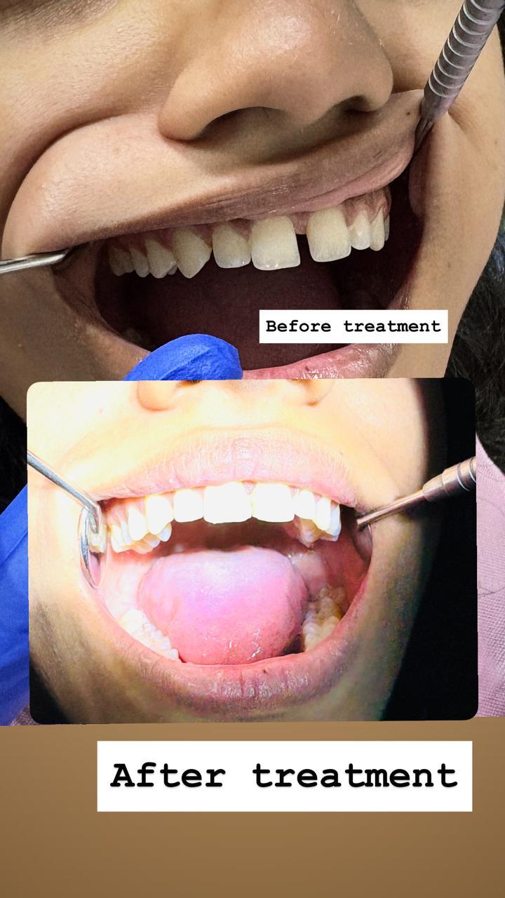 Invisalign & Clear Aligners in Burari — Straighten your smile - invisibly at Braces & Faces, Mayur Vihar Phase 1
